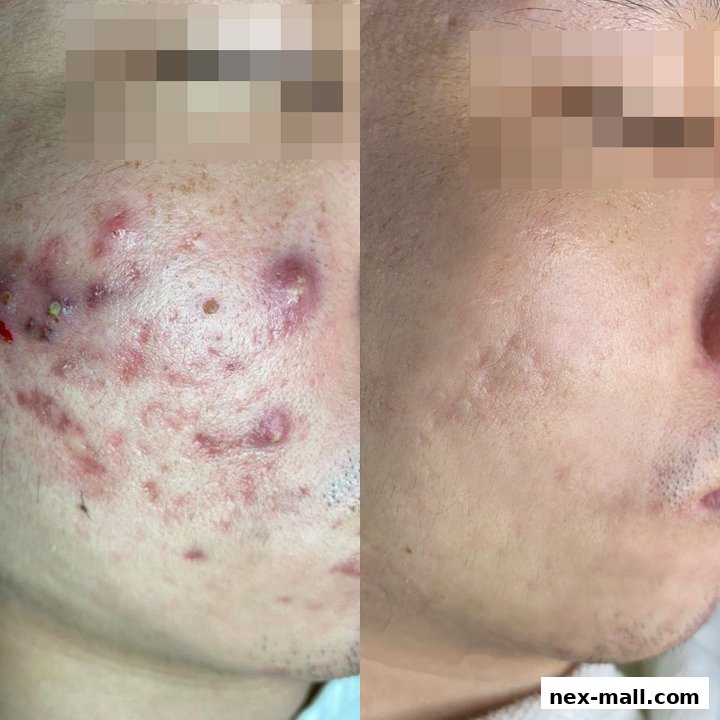 Before and after comparison of facial skin treatment for acne and scarring.