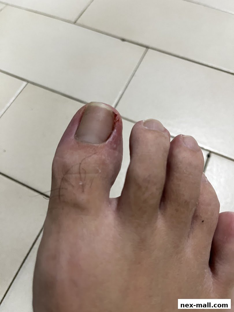 Close-up view of a person's injured toe with redness and a cut near the nail.