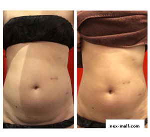 Before and after images showcasing a client's abdominal slimming results.