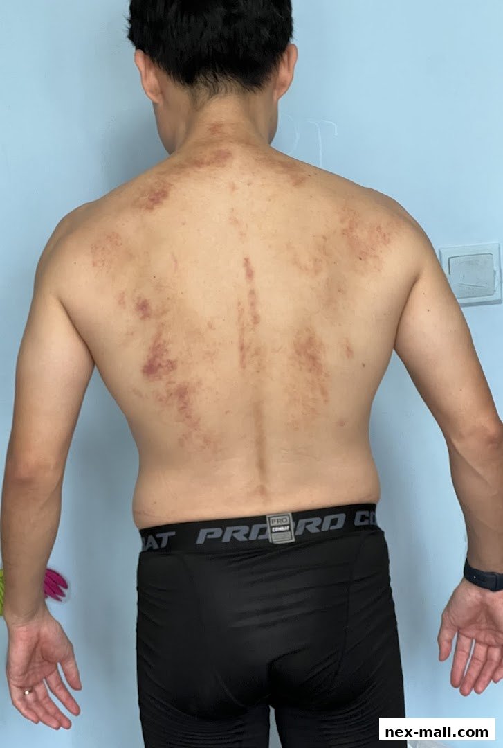 A person's back showing marks from a Gua Sha treatment.