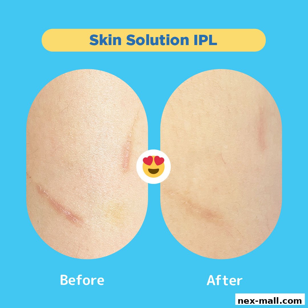Before and after comparison of skin treatment showing scar reduction.