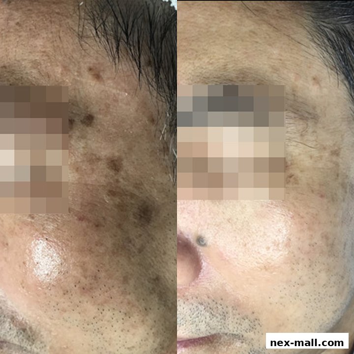 Before and after comparison of facial skin treatment for pigmentation and wrinkles.