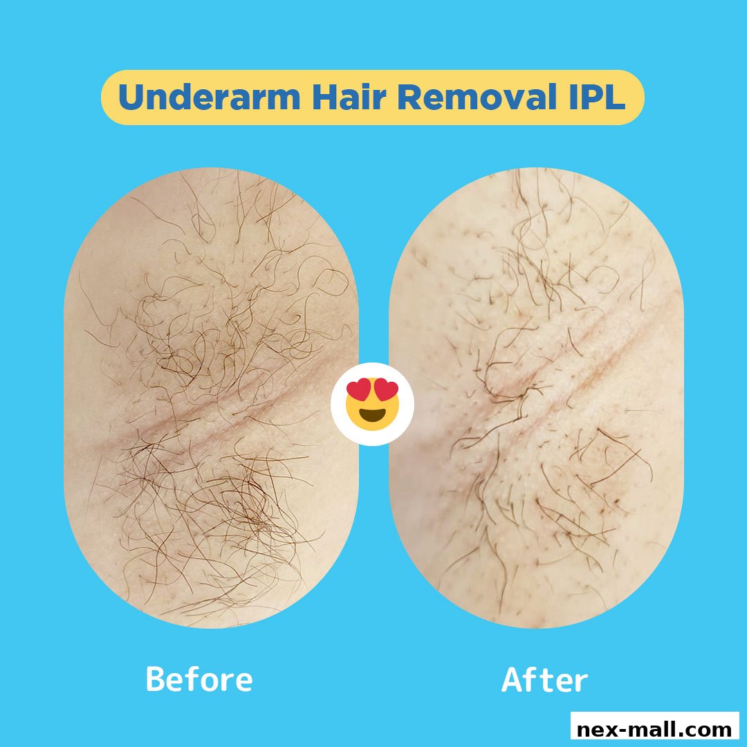 Before and after images showcasing underarm hair removal using IPL technology.