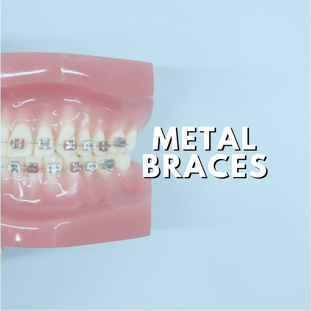 A dental model showcasing metal braces with the text 'METAL BRACES' on a light blue background.