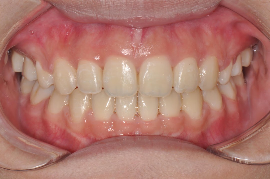A close-up view of a patient's healthy teeth and gums, likely for dental assessment.