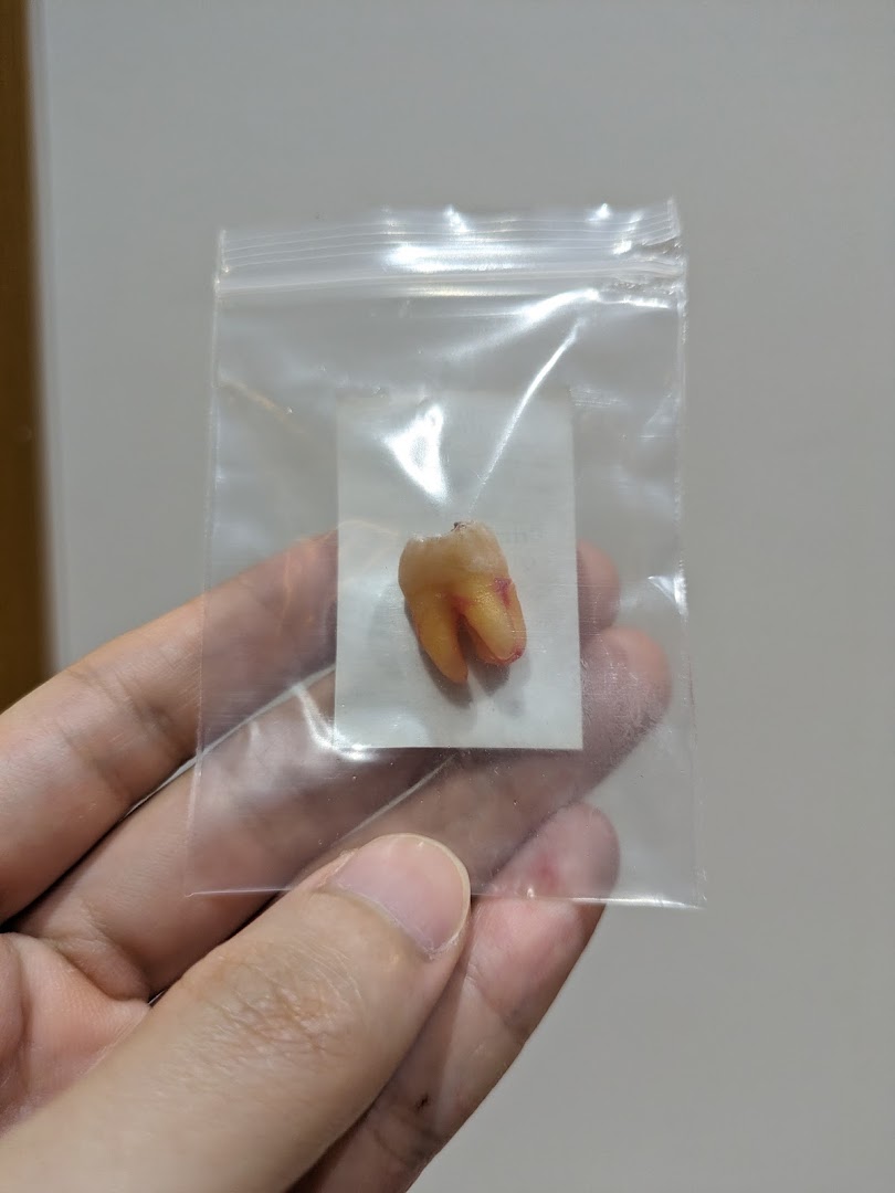 A hand holds a clear plastic bag containing an extracted tooth, likely from a dental procedure.