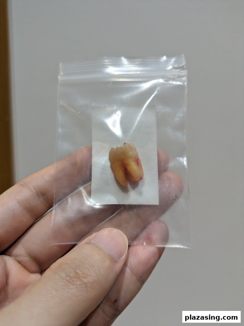 A hand holds a clear plastic bag containing an extracted tooth, likely from a dental procedure.