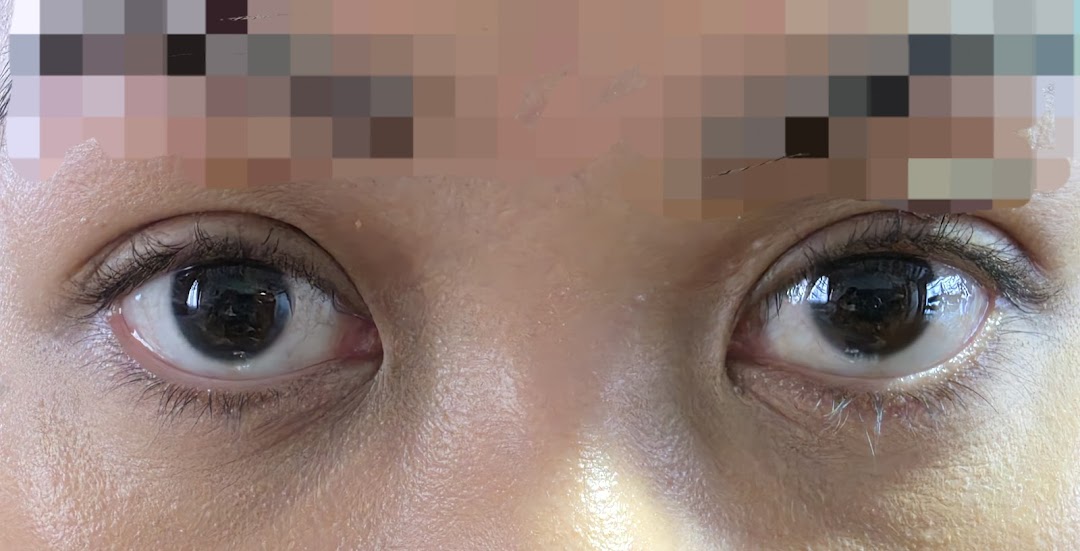 A close-up view of a person's eyes, likely showcasing the results or focus area of a beauty treatment.