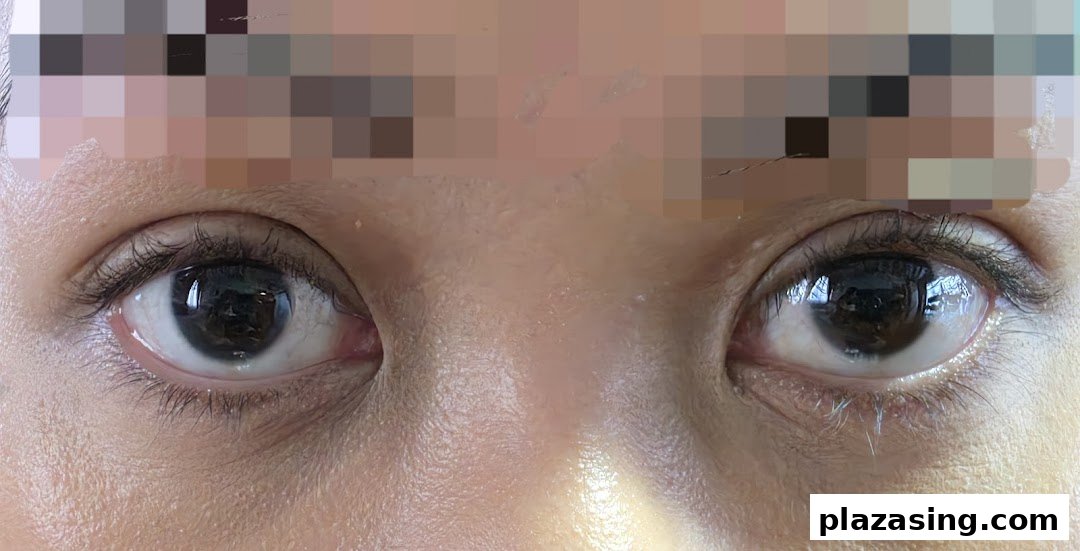 A close-up view of a person's eyes, likely showcasing the results or focus area of a beauty treatment.