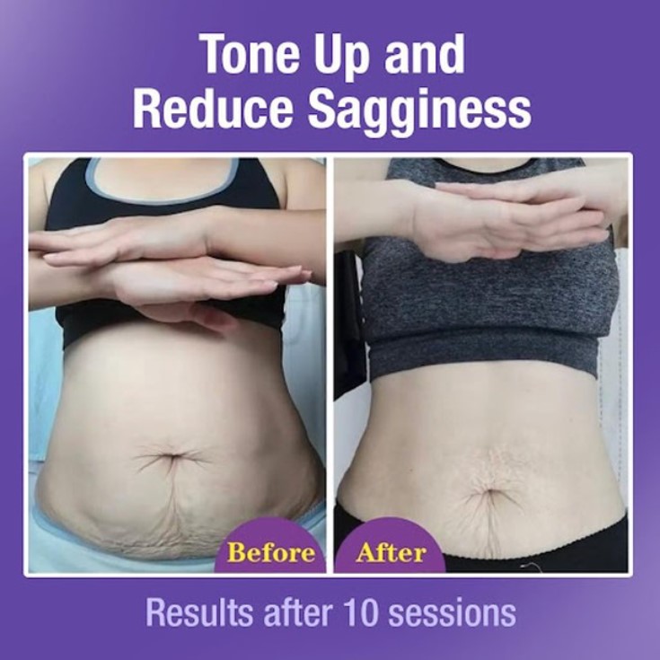 Before and after comparison showing abdominal skin toning and sag reduction results after 10 sessions.