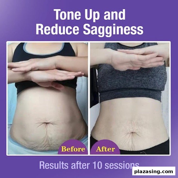 Before and after comparison showing abdominal skin toning and sag reduction results after 10 sessions.