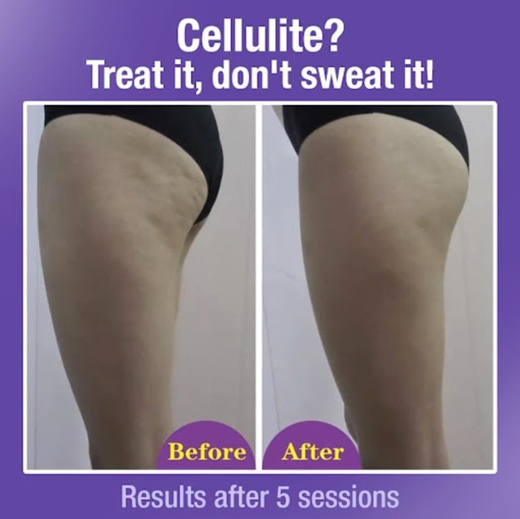 Before and after images showcasing cellulite reduction on a leg after 5 slimming sessions.