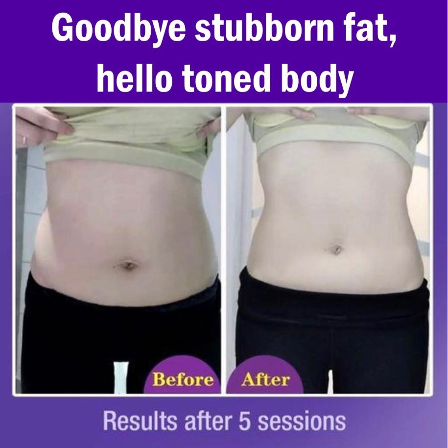 A before-and-after comparison showcasing slimming results on a person's midsection after 5 sessions.