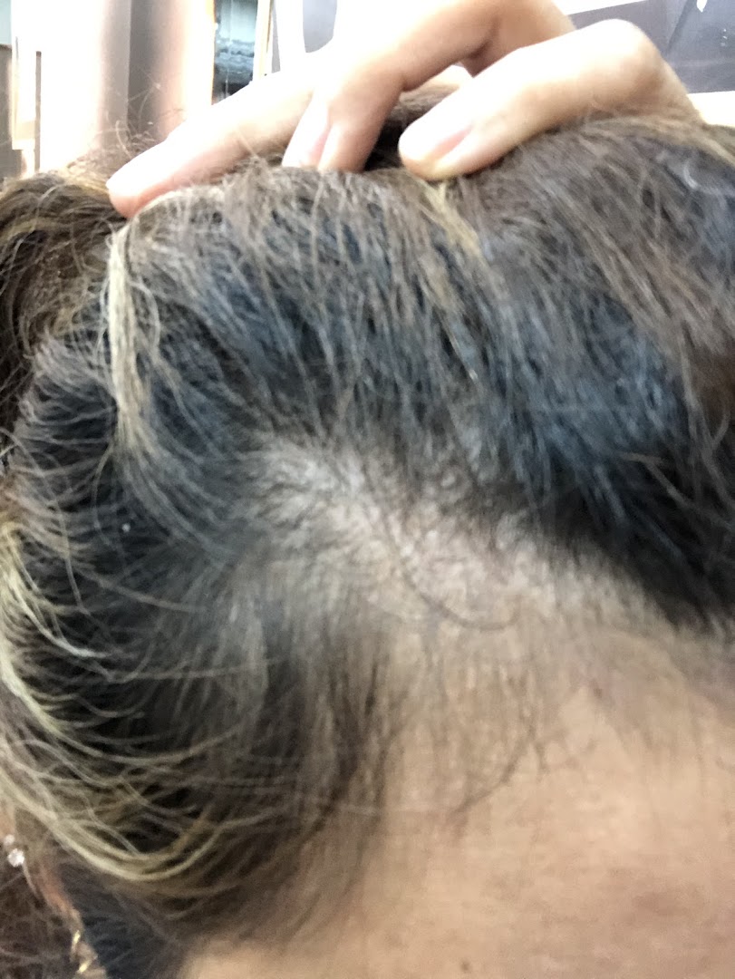Close-up view of a scalp showing hair thinning, indicative of a hair loss concern.
