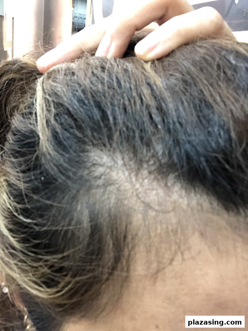 Close-up view of a scalp showing hair thinning, indicative of a hair loss concern.