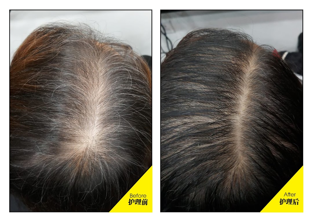 Before and after comparison of a scalp showing improved hair density and health.