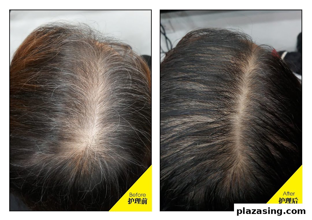 Before and after comparison of a scalp showing improved hair density and health.