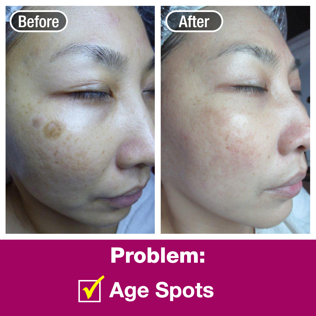Before and after comparison showing the reduction of age spots on a person's face.