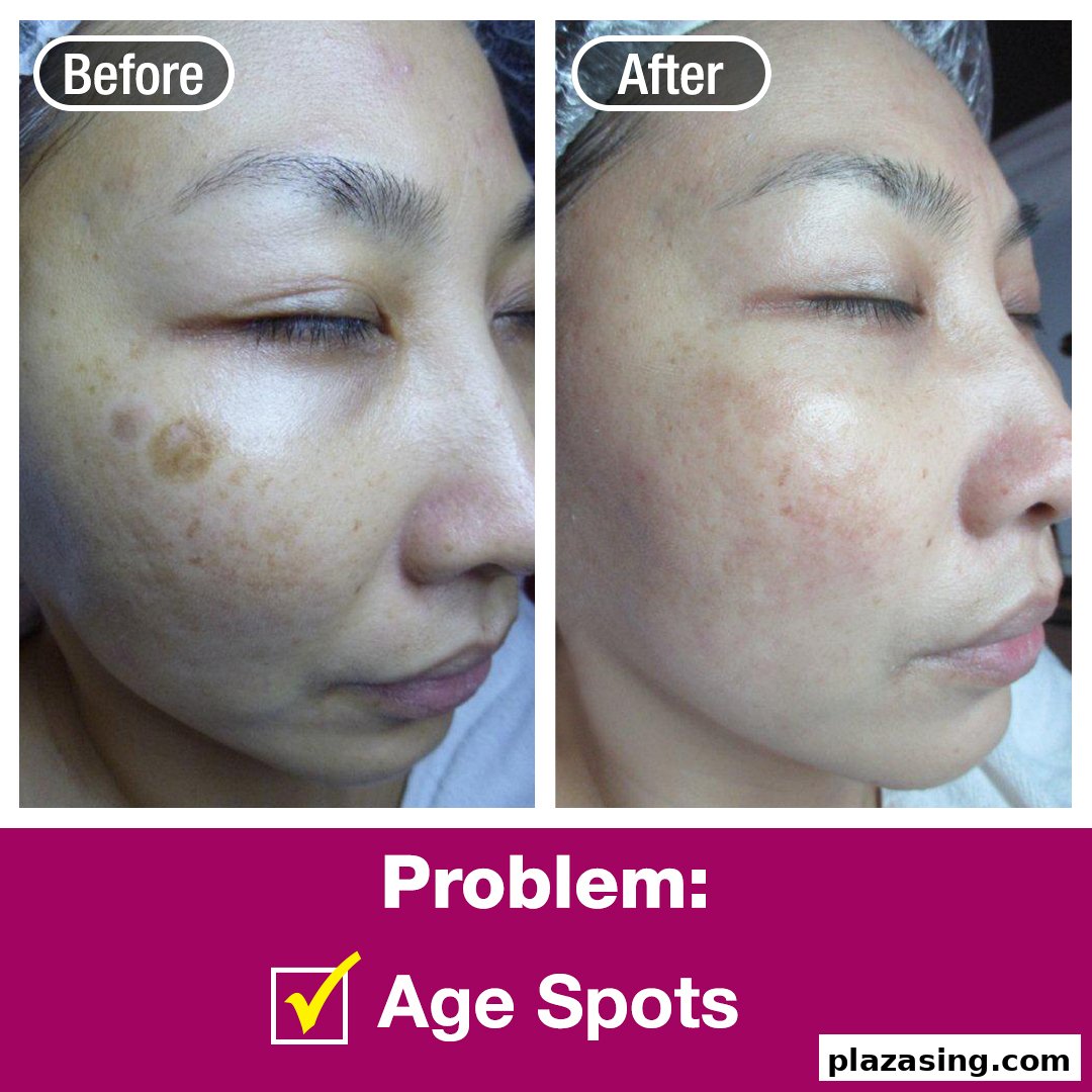 Before and after comparison showing the reduction of age spots on a person's face.