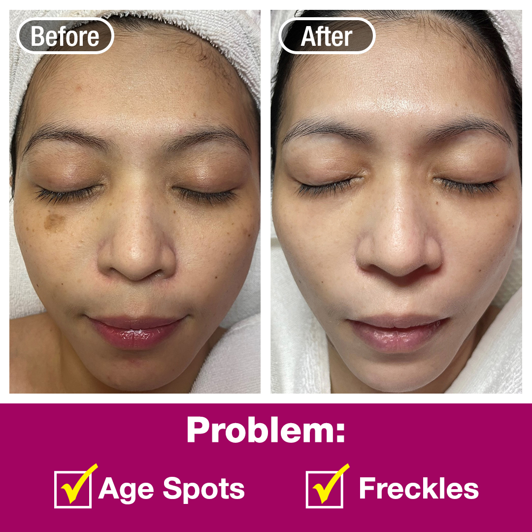 Before and after comparison showcasing effective treatment for age spots and freckles on a person's face.