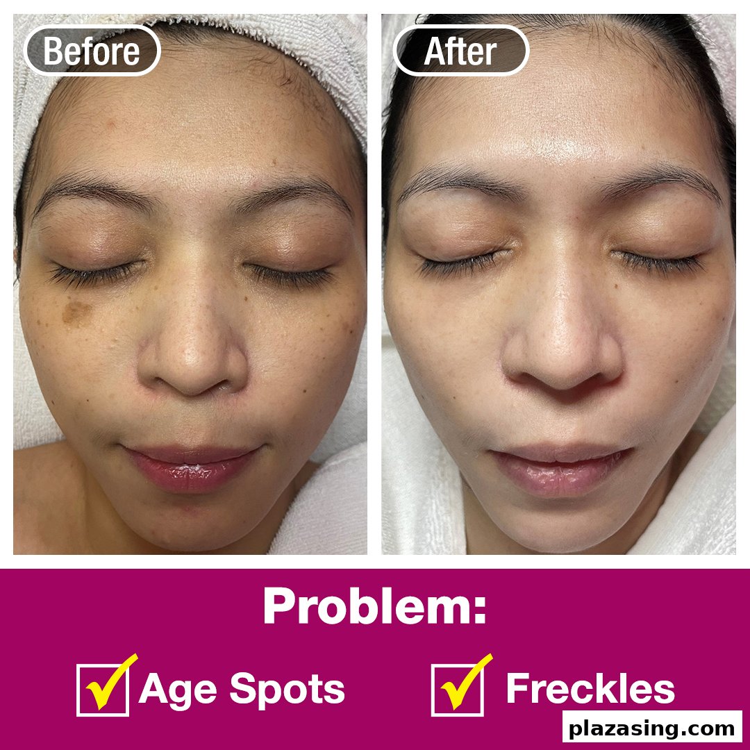 Before and after comparison showcasing effective treatment for age spots and freckles on a person's face.