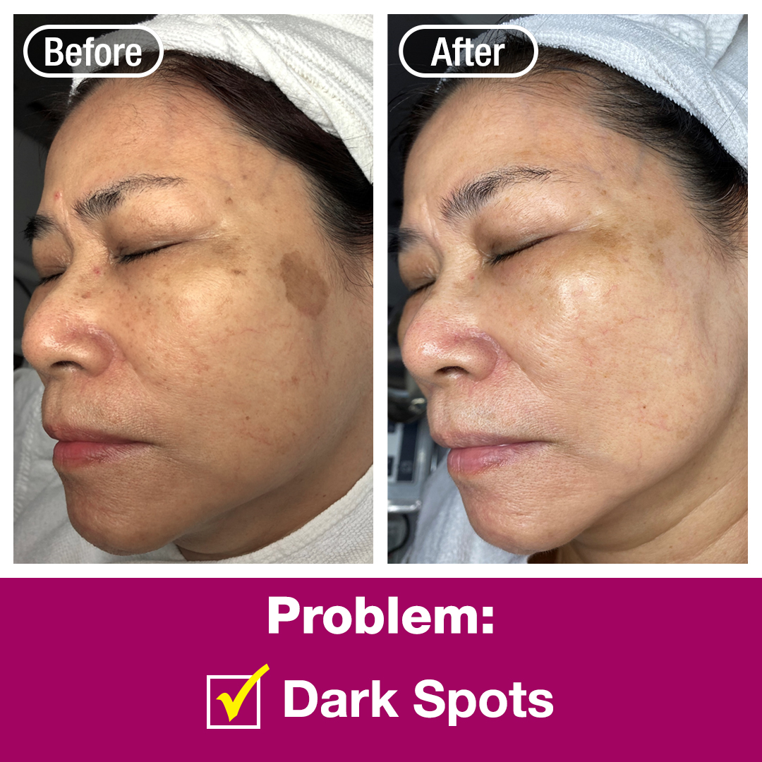 Before and after comparison showing significant reduction of dark spots on a client's face.