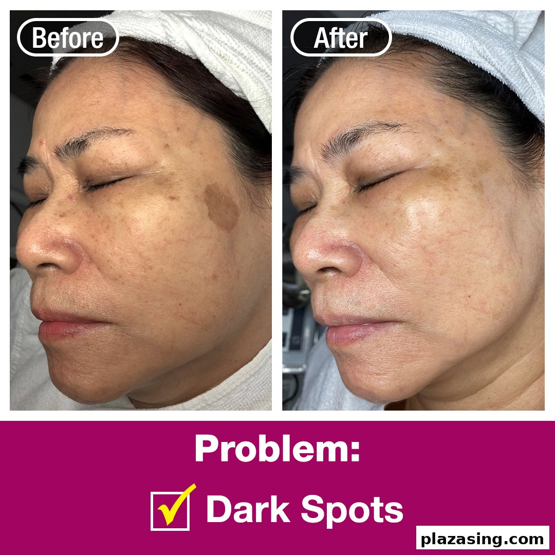 Before and after comparison showing significant reduction of dark spots on a client's face.