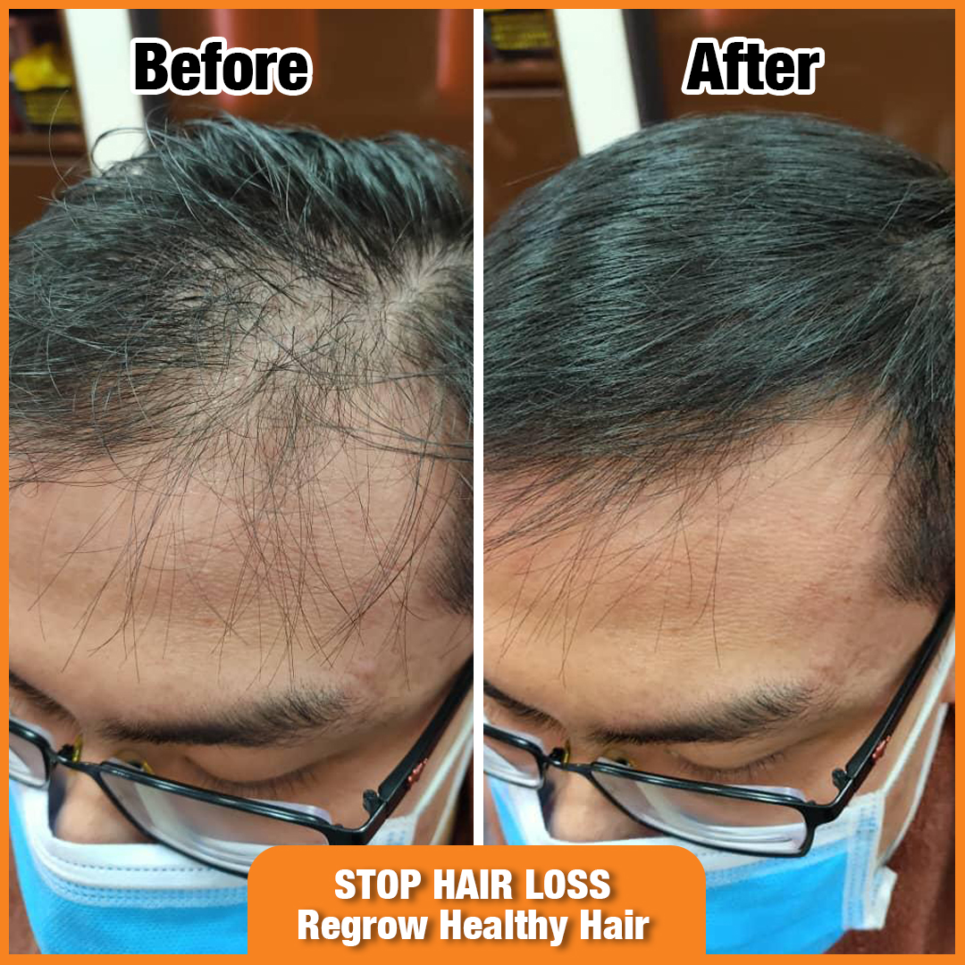 A before-and-after comparison showing significant hair regrowth on a scalp after treatment.