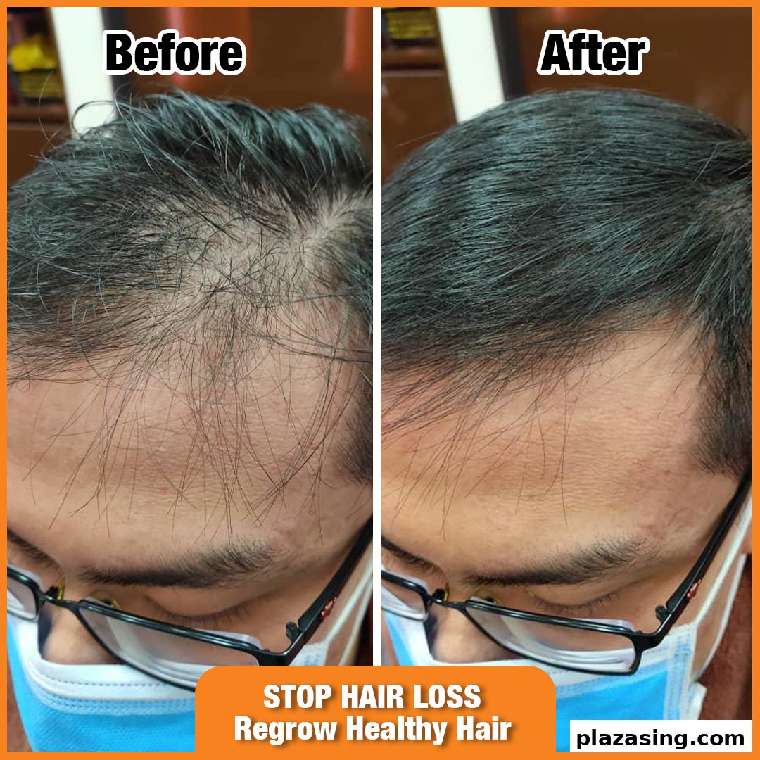 A before-and-after comparison showing significant hair regrowth on a scalp after treatment.