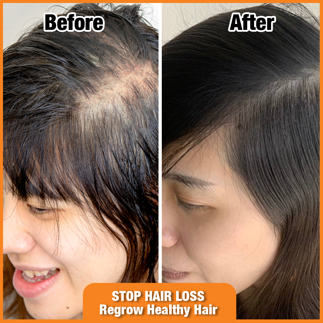 A before and after comparison showing improved hair density and growth from hair treatment.
