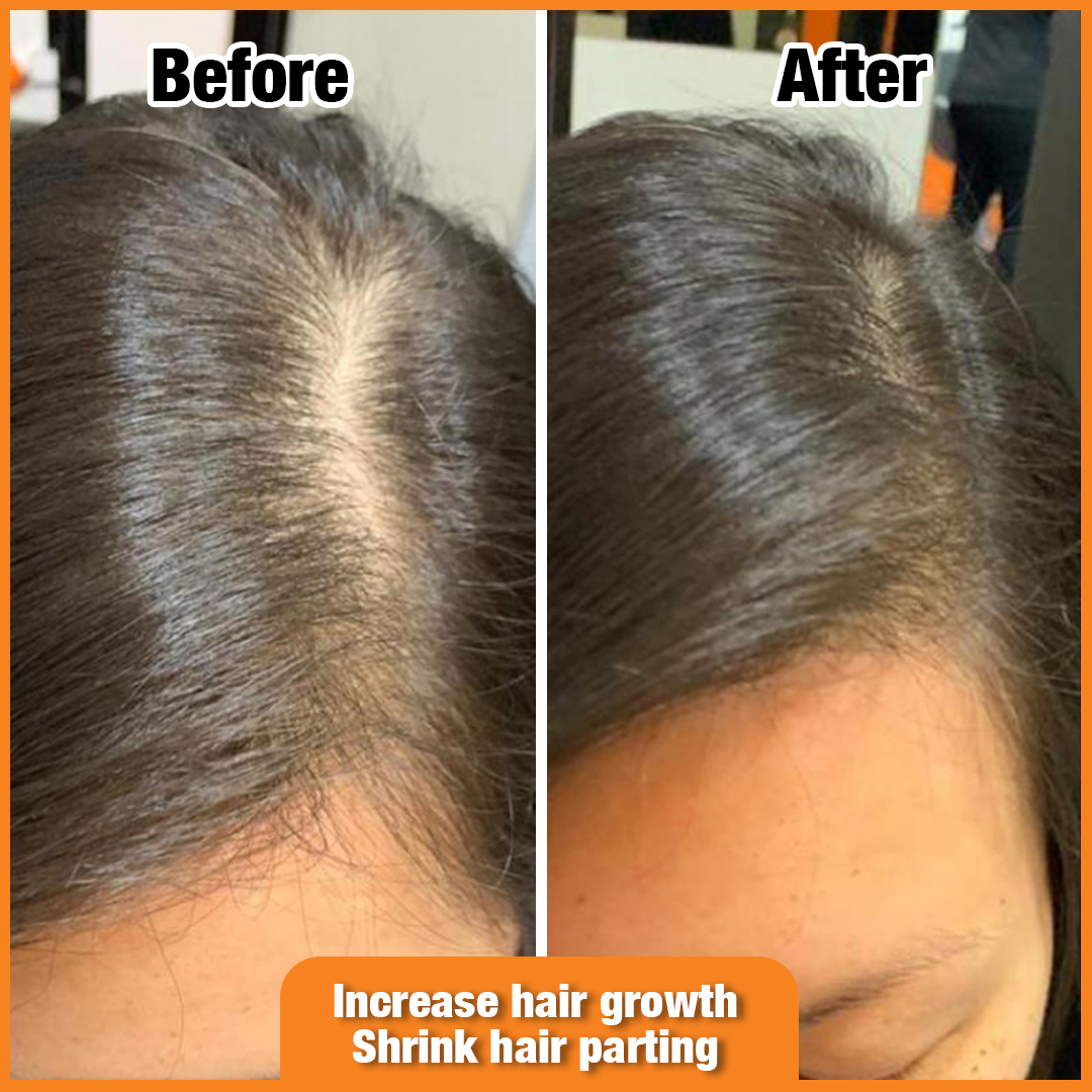Before and after comparison of a scalp showing improved hair density and reduced hair parting.