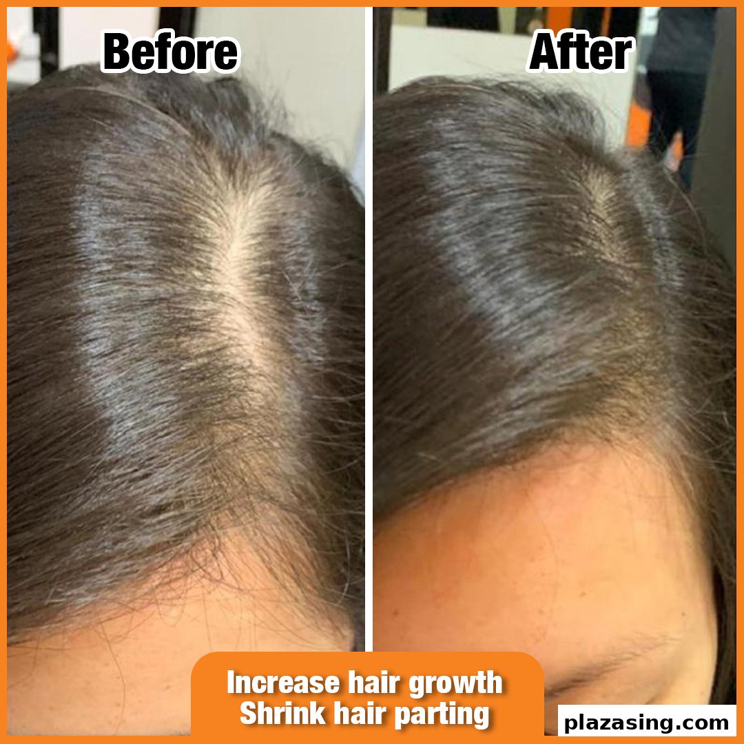Before and after comparison of a scalp showing improved hair density and reduced hair parting.