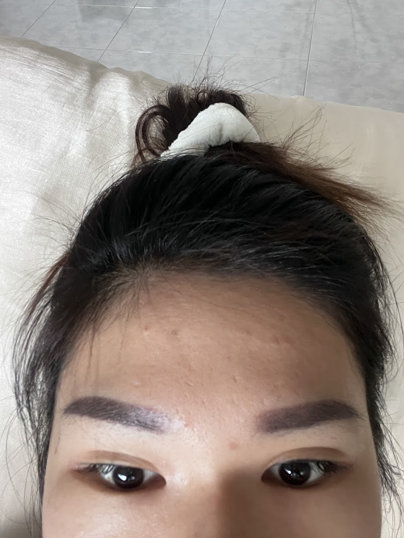Close-up of a person's face showcasing well-defined eyebrows, likely after an aesthetic treatment.