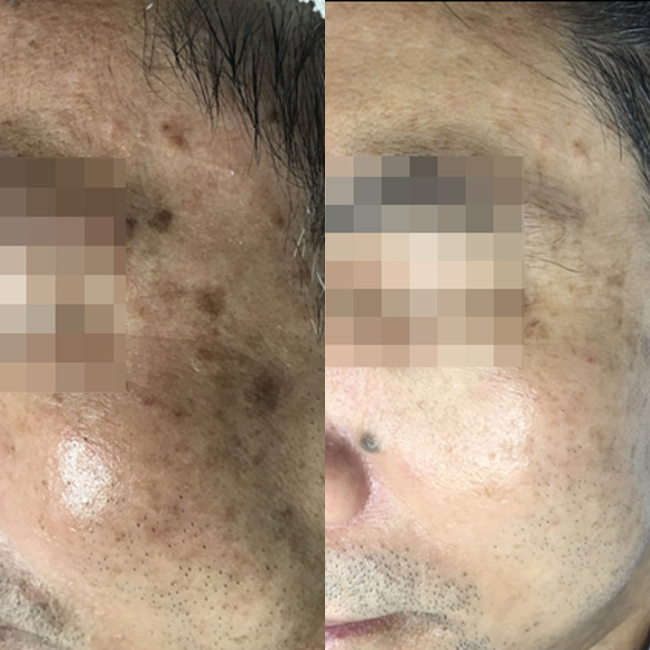 A split image showcasing before and after results of a facial treatment for skin pigmentation.