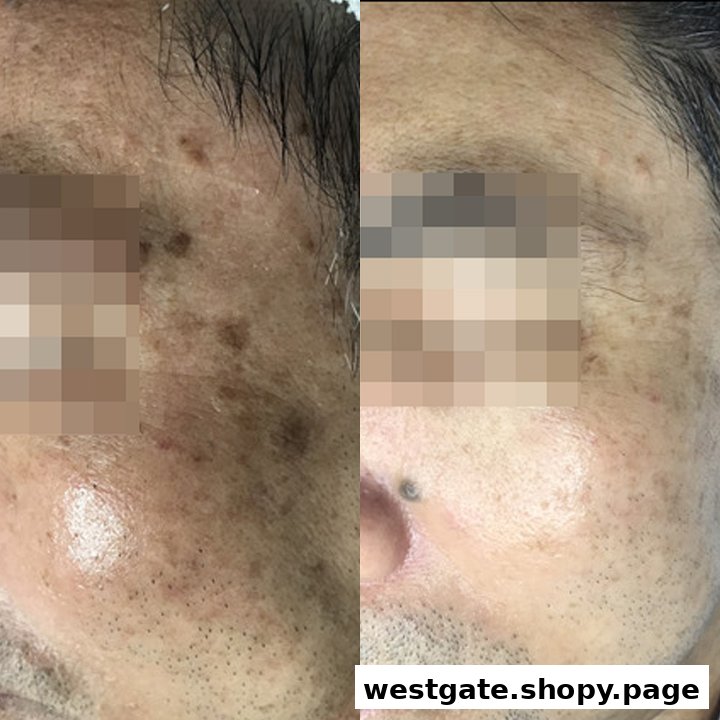 A split image showcasing before and after results of a facial treatment for skin pigmentation.
