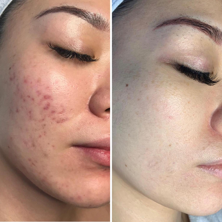Close-up of a person's face showing before and after results of a skin treatment.