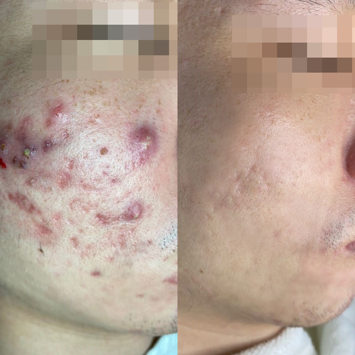 New York Skin Solutions - Westgate  No.1 Facial Treatment Expert  Acne, Wrinkles  Pigmentation Solution image 11