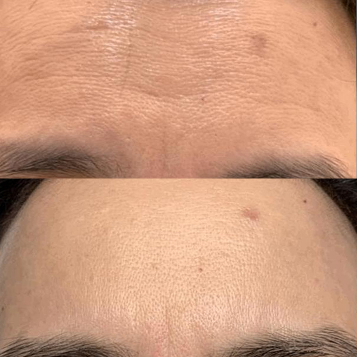 Before and after comparison of a forehead showing significant wrinkle reduction and improved skin texture.