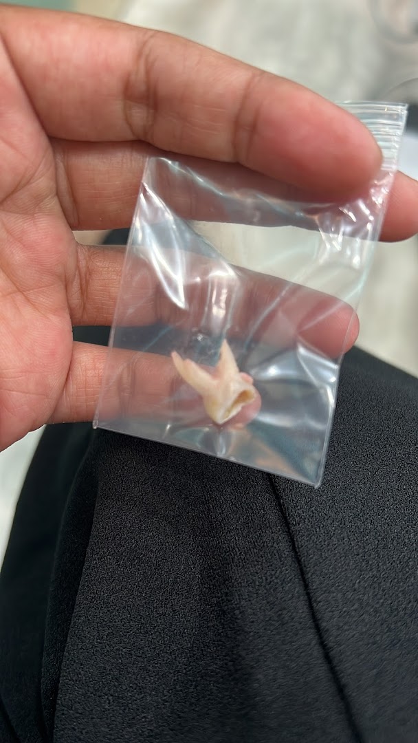 A hand holds an extracted tooth sealed in a small clear plastic bag.