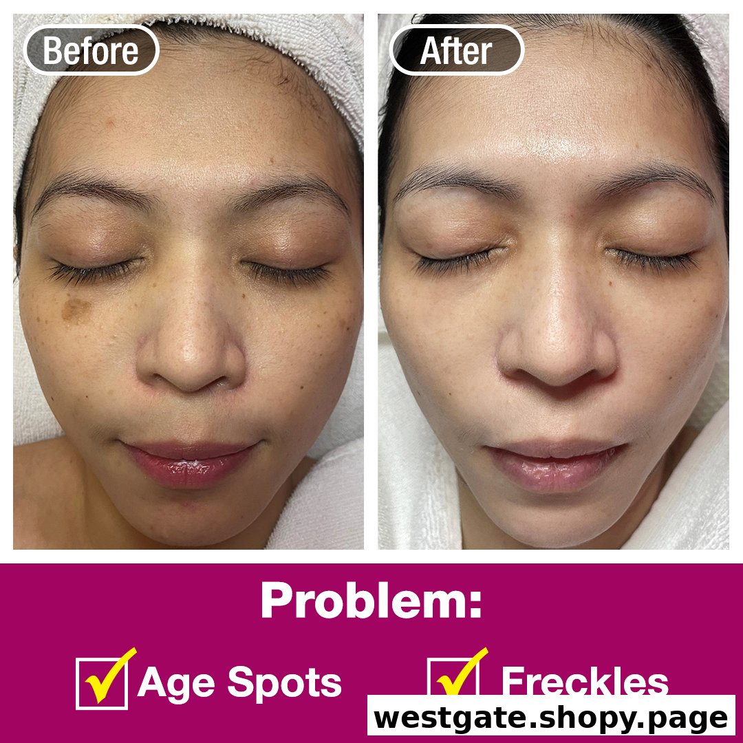 A before-and-after comparison showcasing effective pigmentation and freckle treatment results on a client's face.