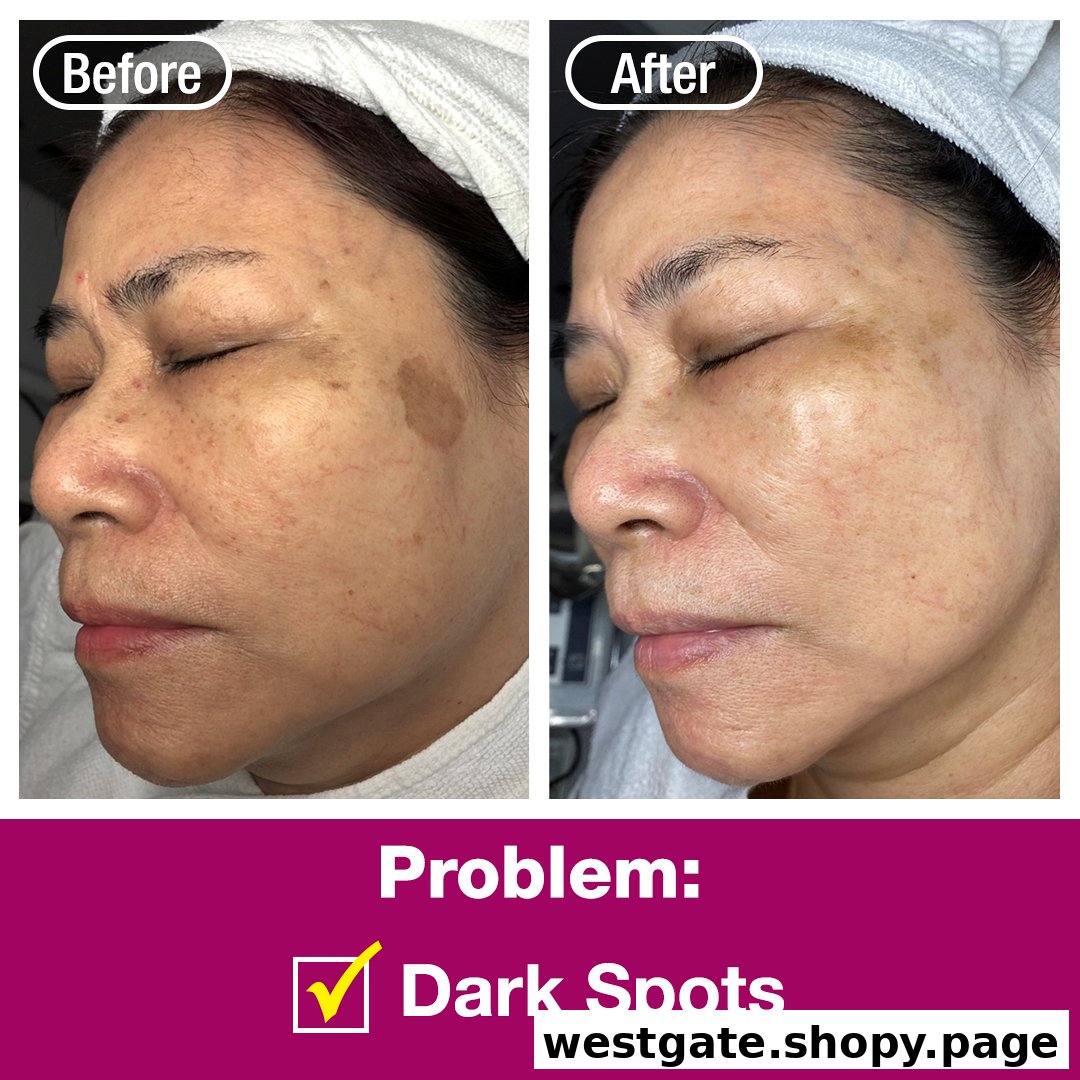 A before-and-after comparison showcasing the reduction of dark spots on a person's face.