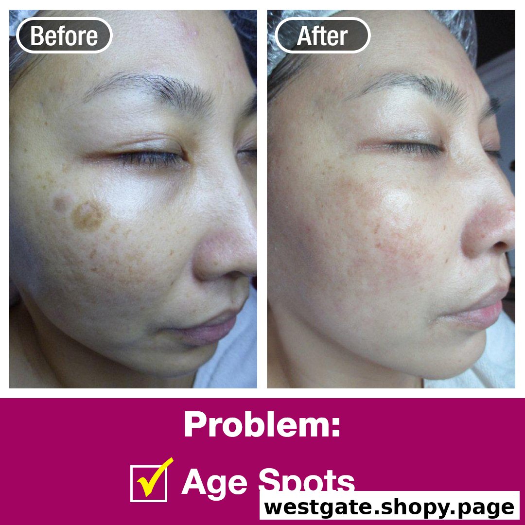 A before-and-after comparison showcasing effective age spot treatment results on a person's face.